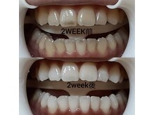 ホワイトニングセンター 那覇国場店/那覇市で可能なホワイトニング