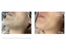 フォーティチュード(FORTITUDE)/地肌も見えてツルすべ髭脱毛