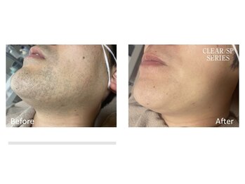 フォーティチュード(FORTITUDE)/地肌も見えてツルすべ髭脱毛