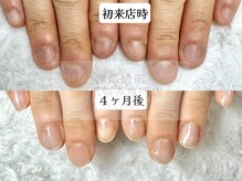 深爪矯正 爪悩み専門店 cocomo/(深爪/長さだし/フィルイン)