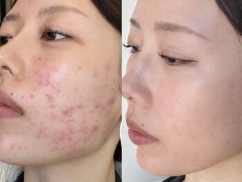 アンティアージュ 福岡本店(antiage)/ニキビや肌荒れなどの肌悩みに