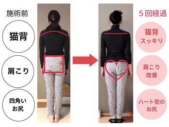いろどり整体/【２０代女性】肩こり、猫背改善