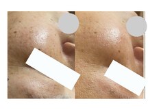 レジュイール(Rejouir)/白玉スノーピーリング