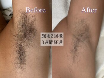 ライズ 岩見沢店(RISE)/【わき脱毛の施術例】