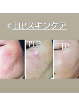 アストリア(ASTORIA)/ハーブピーリングBefore After