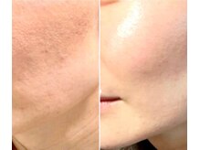 シルクドリバー 大阪店(Silk de River)/プラズマジェット