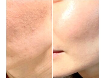 シルクドリバー 大阪店(Silk de River)/プラズマジェット