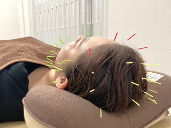 ブロッサム(Blossom)の写真/【美容鍼×首肩・頭皮鍼¥5,500】美容鍼&首肩頭の鍼施術で小顔・美肌効果だけでなく頭痛や睡眠の質改善も◎
