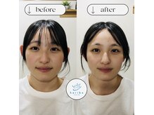 ハリボケア 葛西(haribo care)の雰囲気（【BeforeAfter】むくみや引き締めに美容鍼が効果を発揮します◎）