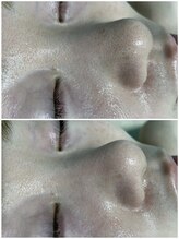 ディオラビューティーサロン(Diora)/ピーリングビフォーアフター