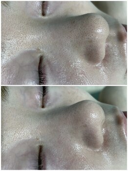 ディオラビューティーサロン(Diora)/ピーリングビフォーアフター