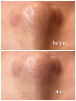 ルウ(Ruu.)/韓国式3D毛穴洗浄