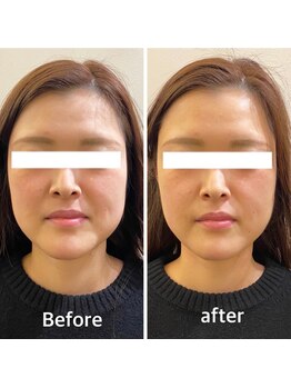 ミル(milu)/小顔も一回で体感頂けます！