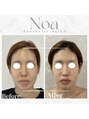 ノア 新宿(Noa) 小顔矯正