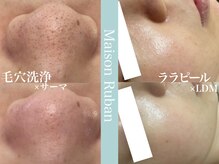 メゾンリュバン 梅田店(Maison Ruban)の雰囲気（毛穴改善プログラム［ピーリング/毛穴/毛穴洗浄/黒ずみ毛穴］）