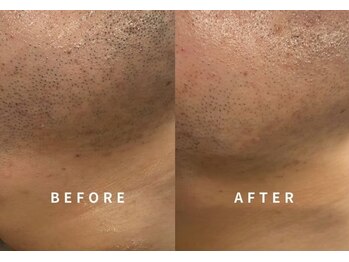 シード(SHE°)/ヒゲ脱毛