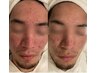 【メンズ本気で改善したい方専用】ニキビ毛穴でお悩みの方はこちら★