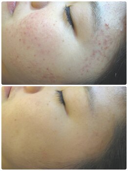 ユフラ(Juhla)/韓国式ハーブピーリング