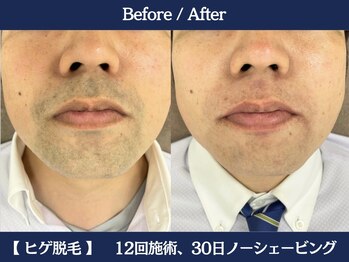 ランドマーク 中崎町(LANDMARK.)/《 鼻下・口下・あご 》