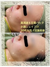 フォルチェ ゆめタウン東広島店(Folche)/高周波フェイシャル