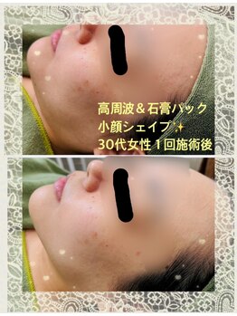 フォルチェ ゆめタウン東広島店(Folche)/高周波フェイシャル