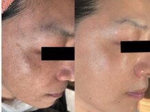 ラヴィ(Ravi)/くすみ、ザラつき、シミケア