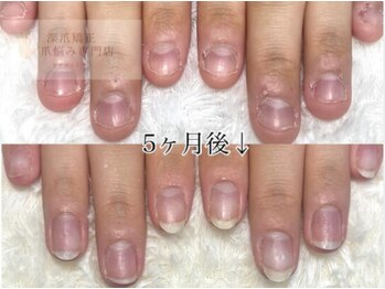 ココモ(cocomo)/(深爪/長さだし/フィルイン) 