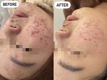 エレン(Elen)/【ニキビにアプローチ】