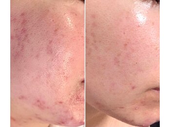 シルクドリバー 大阪店(Silk de River)/プラズマジェット