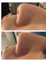 エリー(ERIE)/ハーブピーリング毛穴黒ずみ除去