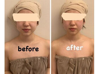 ララ(LALA)/小顔/美肌/もたつきのない小顔に