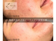 マーヤ(Ma-ya)の雰囲気（ガリレオピーリングで肌免疫力を上げてトラブルの出にくい肌へ）