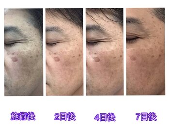 ラ スター 関内店(La star)/シミにアプローチ!シミケア