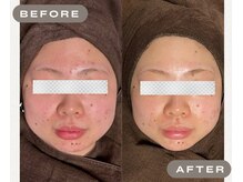 ガーオガーオ 新宿 四ツ谷(GaaoGaao)/ハーブピーリング/2回目