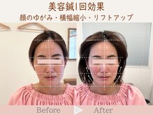 ネテマテ 表参道(netemate)/美容鍼