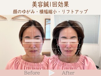 ネテマテ 表参道(netemate)/美容鍼