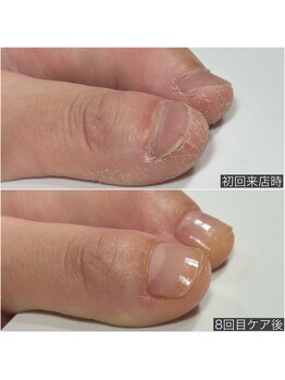 自爪育成ネイルケア