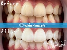 ホワイトニングカフェ 上田店(WhiteningCafe)/ホワイトニングビフォーアフター