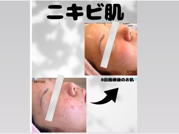 ワン(One)/ニキビ