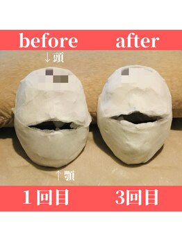 ロータス ビューティー(LOTUS Beauty)/石膏パックビフォーアフター