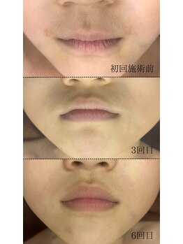 ヴィヴィオドット(vivio.)/顔脱毛・鼻下の毛脱毛効果