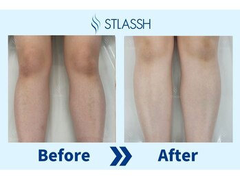 ストラッシュ つくば店(STLASSH BiVi)/施術例：ひざ下