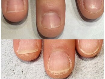 グレースレディ/深爪矯正の実績