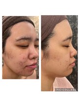 チャマ 高知店(CHAMA) 毛穴 ピーリング