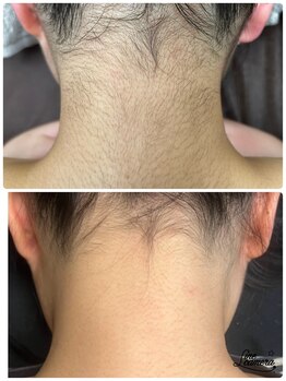 サロンエム 西荻窪(salon M)/うなじワックス×光脱毛