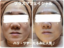 Ｎｅｗマシーン，プラズマフェイシャルあらゆる肌悩みに対応！