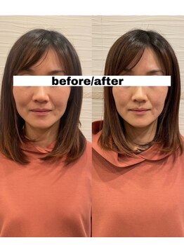 長寿鍼灸院 長寿整骨院/美容鍼50本の効果★（１回目）