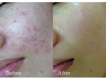 綺麗サロン 脱毛アンドフェイシャル ジュエル(Jewel)/【4BミネラルクリアTR】