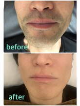 リッチアンビューティー(Rich.an beauty)/美肌ヒゲ脱毛