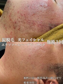 サロン ド マキ(Salon de Maki)/肌質改善の特別なメニュー!